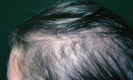 Female hair loss – why does hair loss happen to women?