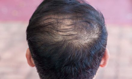 Causes of Hair Loss – Uncovering the Top 5 Common Reasons